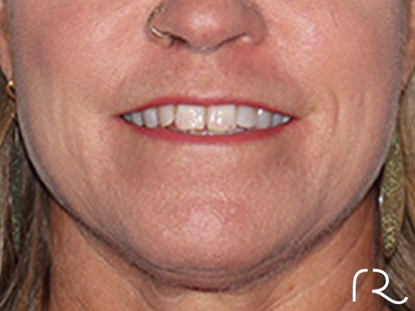 Lip Lift Before & After Gallery - Patient 155005 - Image 1