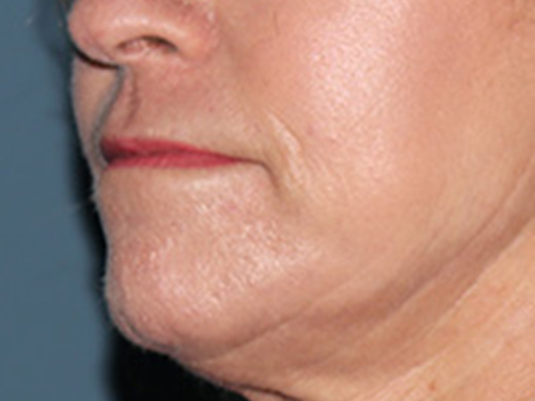 Lip Lift Before & After Gallery - Patient 155005 - Image 3