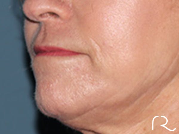 Lip Lift Before & After Gallery - Patient 155005 - Image 3