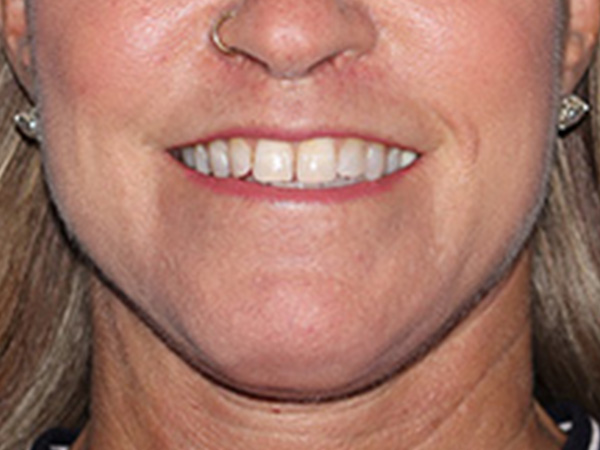 Lip Lift Before & After Gallery - Patient 155005 - Image 2