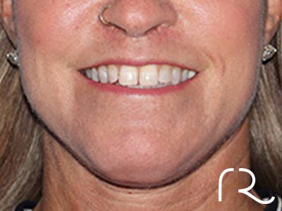 Lip Lift Before & After Gallery - Patient 155005 - Image 2
