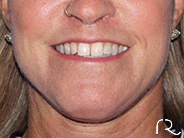 Lip Lift Before & After Gallery - Patient 155005 - Image 2