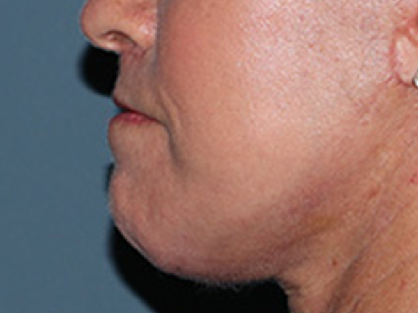 Lip Lift Before & After Gallery - Patient 155005 - Image 6