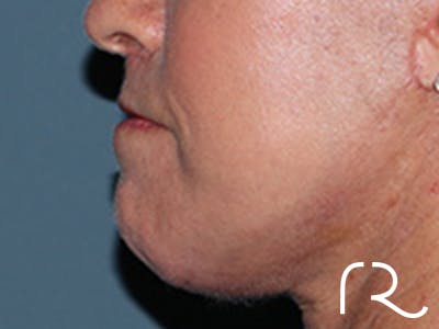 Lip Lift Before & After Gallery - Patient 155005 - Image 6