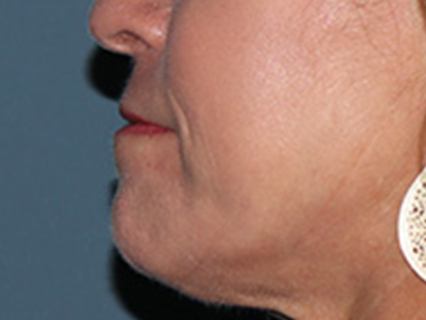 Lip Lift Before & After Gallery - Patient 155005 - Image 5
