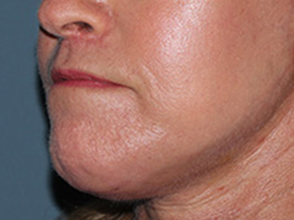 Lip Lift Before & After Gallery - Patient 155005 - Image 4
