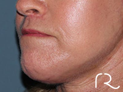 Lip Lift Before & After Gallery - Patient 155005 - Image 4