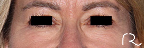 Eyelid Surgery Before & After Gallery - Patient 808901 - Image 1