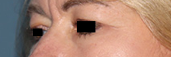 Eyelid Surgery Before & After Gallery - Patient 808901 - Image 3