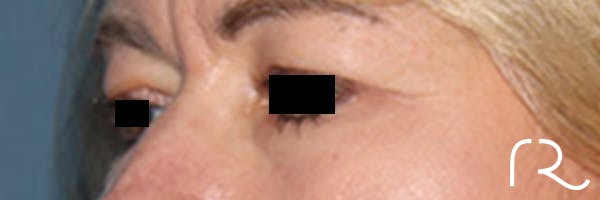 Eyelid Surgery Before & After Gallery - Patient 808901 - Image 3
