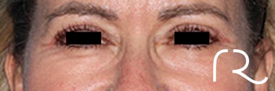 Eyelid Surgery Before & After Gallery - Patient 808901 - Image 2