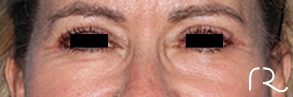 Eyelid Surgery Before & After Gallery - Patient 808901 - Image 2