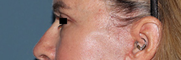 Eyelid Surgery Before & After Gallery - Patient 808901 - Image 6