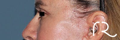 Eyelid Surgery Before & After Gallery - Patient 808901 - Image 6