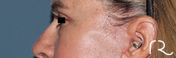 Eyelid Surgery Before & After Gallery - Patient 808901 - Image 6