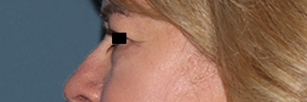 Eyelid Surgery Before & After Gallery - Patient 808901 - Image 5