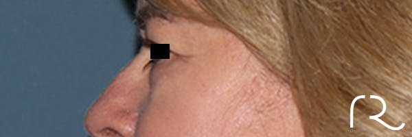 Eyelid Surgery Before & After Gallery - Patient 808901 - Image 5