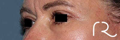 Eyelid Surgery Before & After Gallery - Patient 808901 - Image 4