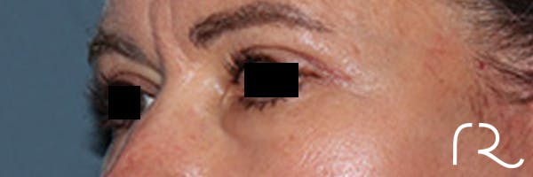 Eyelid Surgery Before & After Gallery - Patient 808901 - Image 4