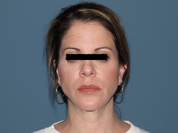 R2 Extended Deep Neck Lift Before & After Gallery - Patient 125910 - Image 5