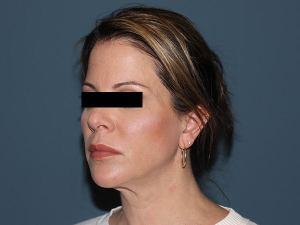Facelift Before & After Gallery - Patient 164921 - Image 1
