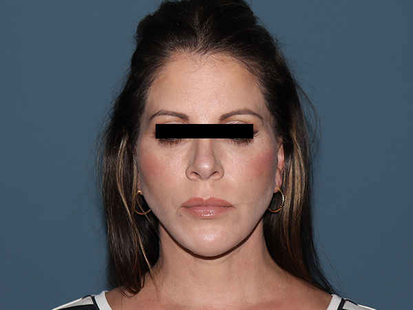 R2 Extended Deep Neck Lift Before & After Gallery - Patient 125910 - Image 6