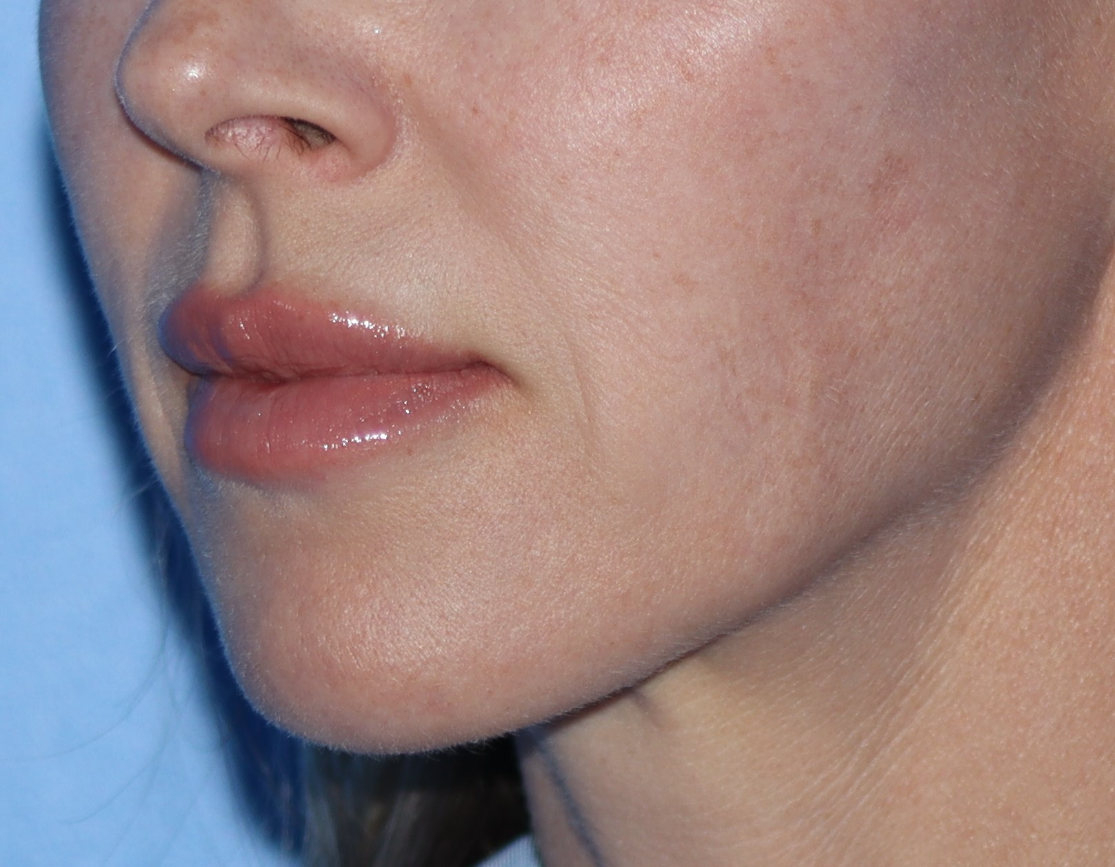 Lip Lift Before & After Gallery - Patient 375777 - Image 1