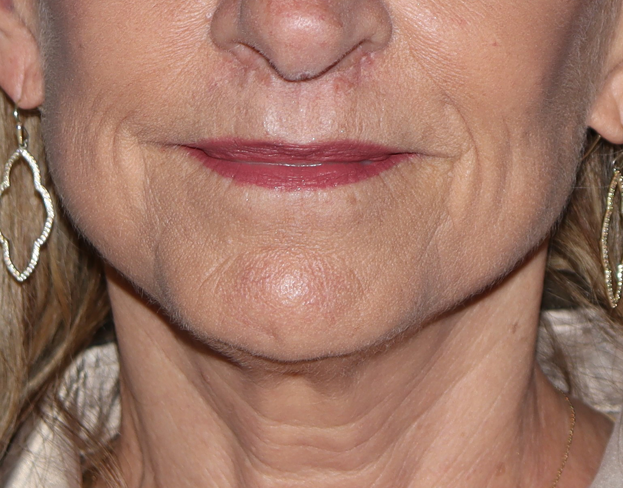 Lip Lift Before & After Gallery - Patient 323817 - Image 1