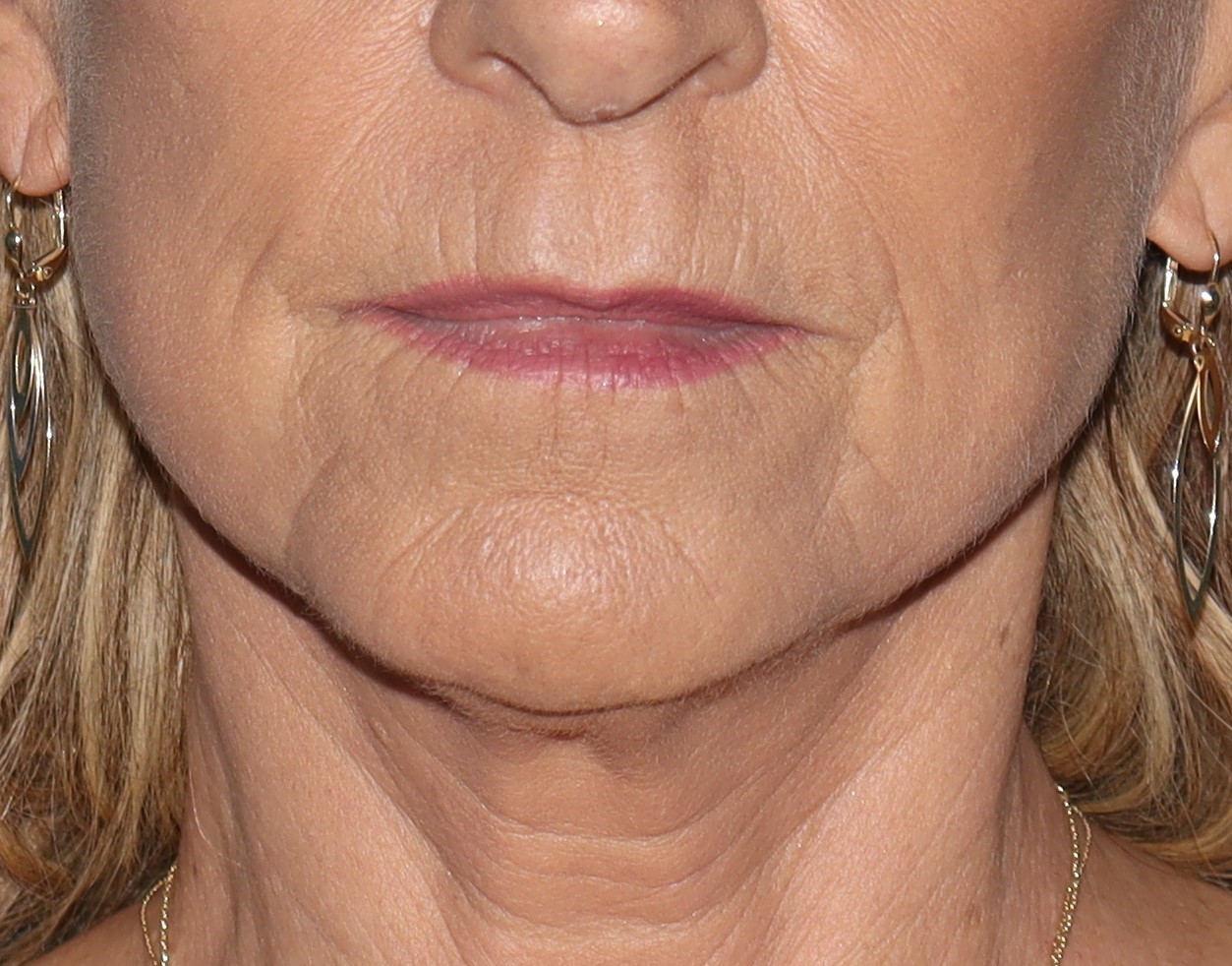 Lip Lift Before & After Gallery - Patient 323817 - Image 2