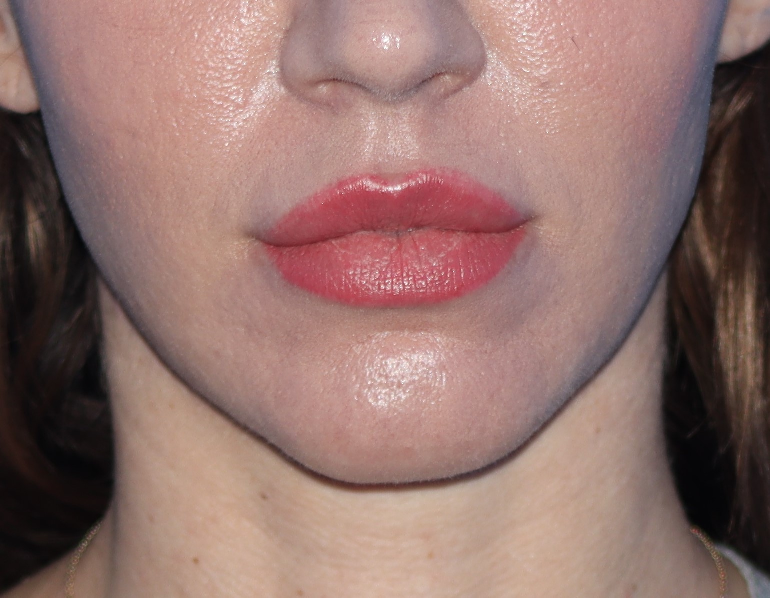 Lip Lift Before & After Gallery - Patient 277886 - Image 1