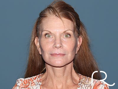 Facelift Before & After Gallery - Patient 815628 - Image 4