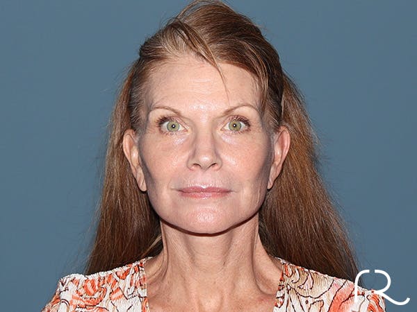 Facelift Before & After Gallery - Patient 815628 - Image 4