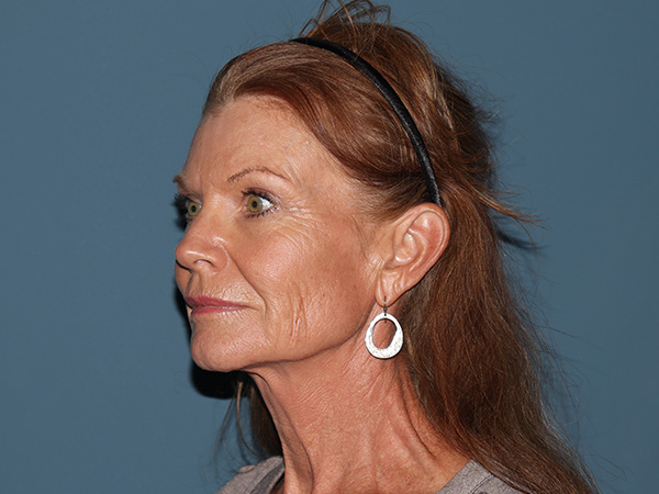 Neck Lift Before & After Gallery - Patient 208935 - Image 1