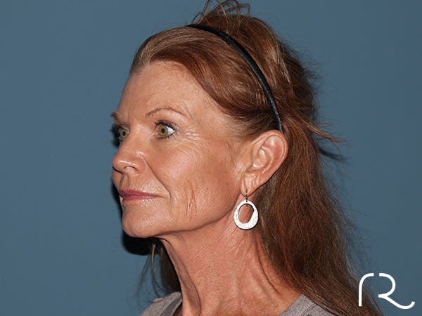 Facelift Before & After Gallery - Patient 815628 - Image 1