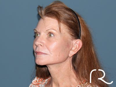 Facelift Before & After Gallery - Patient 815628 - Image 2