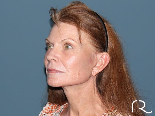 Facelift Before & After Gallery - Patient 815628 - Image 2