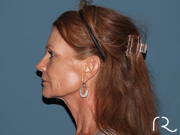 Facelift Before & After Gallery - Patient 815628 - Image 5