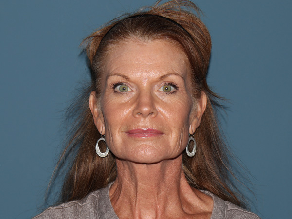 Fractional CO2 Laser Resurfacing Before & After Gallery - Patient 324899 - Image 1