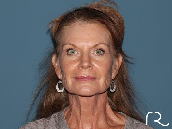 Facelift Before & After Gallery - Patient 815628 - Image 3