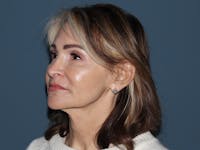 Fractional CO2 Laser Resurfacing Before & After Gallery - Patient 137125 - Image 1