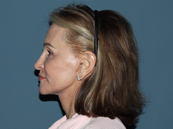 Fractional CO2 Laser Resurfacing Before & After Gallery - Patient 137125 - Image 4