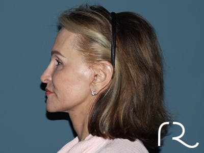 Neck Lift Before & After Gallery - Patient 264190 - Image 4