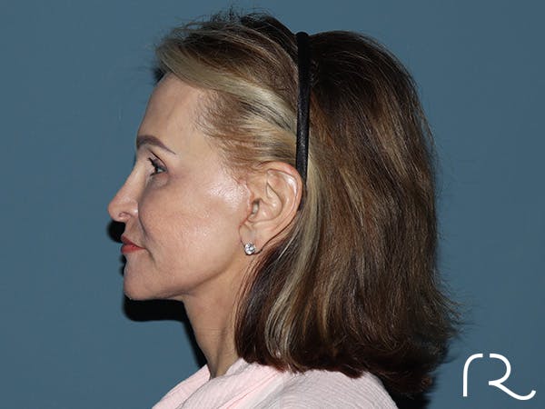 Neck Lift Before & After Gallery - Patient 264190 - Image 4