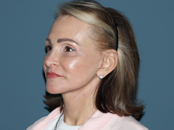 Fractional CO2 Laser Resurfacing Before & After Gallery - Patient 137125 - Image 2