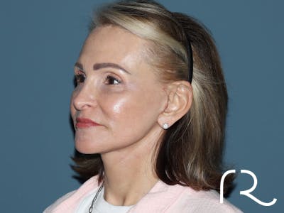 Neck Lift Before & After Gallery - Patient 264190 - Image 2