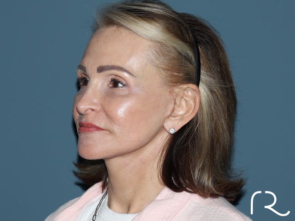 Neck Lift Before & After Gallery - Patient 264190 - Image 2