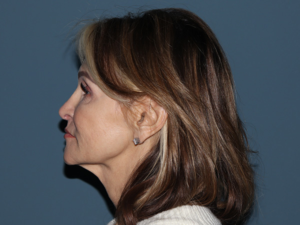 Fractional CO2 Laser Resurfacing Before & After Gallery - Patient 137125 - Image 3