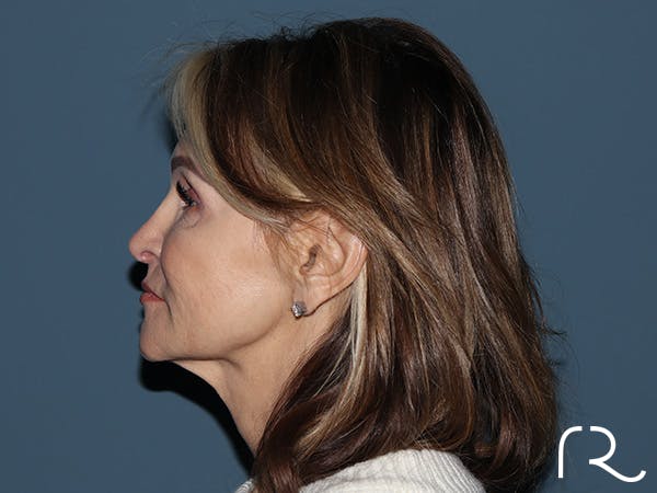 Neck Lift Before & After Gallery - Patient 264190 - Image 3