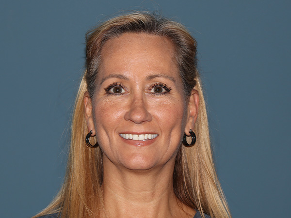 Fractional CO2 Laser Resurfacing Before & After Gallery - Patient 250242 - Image 1