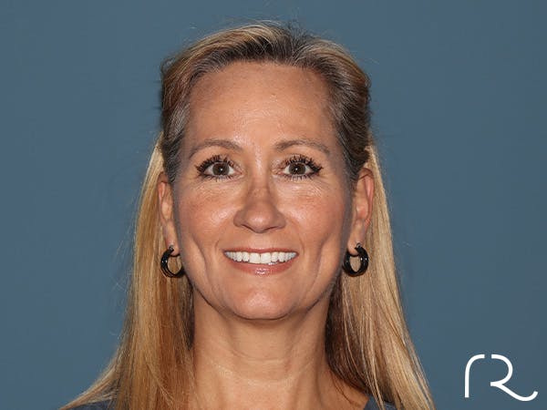 Fractional CO2 Laser Resurfacing Before & After Gallery - Patient 250242 - Image 1